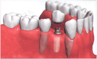 Dental Implants - Redhill Dental Practice